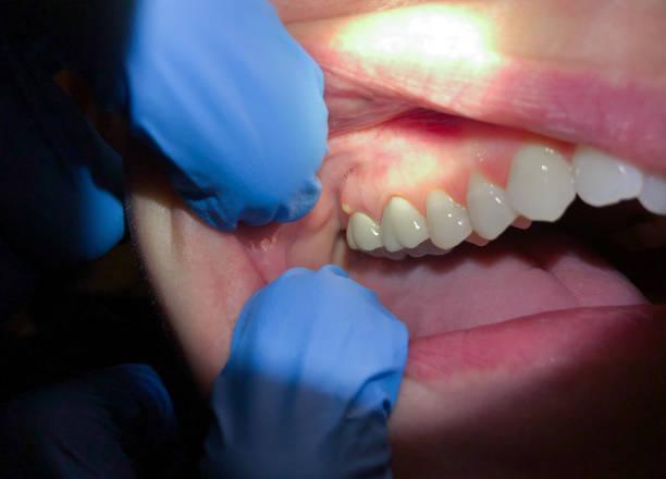 Best Tooth Infection Emergency Dentist  in Pitcairn, PA
